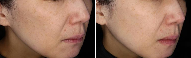 ピコレーザーPQX：老人性色素斑・肝斑 施術前／2回照射後1か月