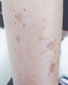 シミ取りレーザー:シミ取りYAGレーザー+トレチノイン 治療前