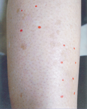 シミ取りレーザー:シミ取りYAGレーザー+トレチノイン 2か月後