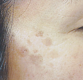 シミ取りレーザー:シミ取りYAGレーザー 治療前