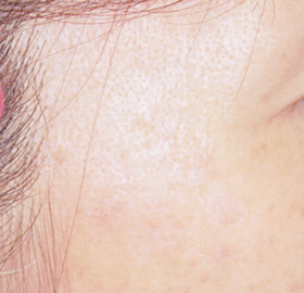 シミ取りレーザー:シミ取りYAGレーザー レーザー照射後 瘡蓋取れた後