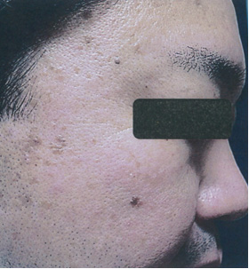 シミ取りレーザー:CO2レーザー 治療前