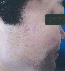 シミ取りレーザー:CO2レーザー 1回目治療後