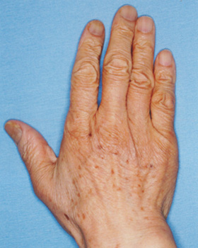 シミ取りレーザー:シミ取りYAGレーザー+CO2レーザー 治療前