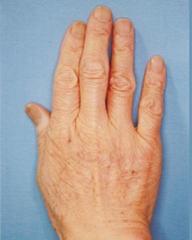 シミ取りレーザー:シミ取りYAGレーザー+CO2レーザー 5回目治療後