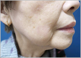 シミ取りレーザー:シミ取りYAGレーザー 1回目治療後