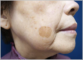 シミ取りレーザー:シミ取りYAGレーザー 治療前