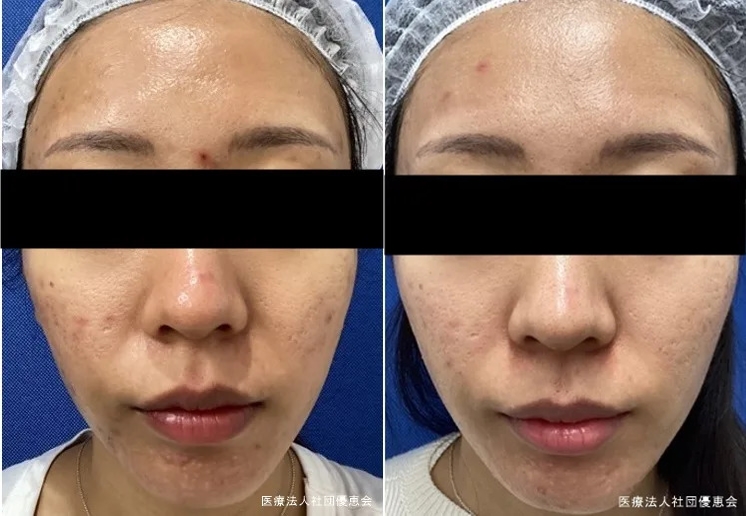 AP+ジェネシス全顔+イオン導入(ビヨンセ点滴ライト) 10回 治療前 / 治療後