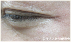 ベビーコラーゲン 目尻 1回目直後