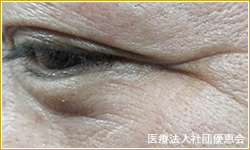 ベビーコラーゲン 目尻 治療前