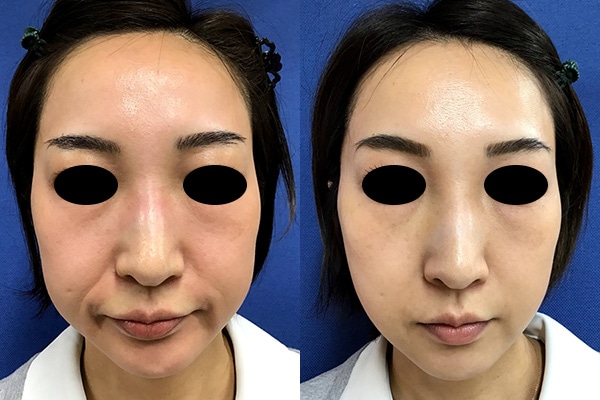 CPC-PRP(高濃度プレミアムPRP)全顔1回 施術前/1週間後