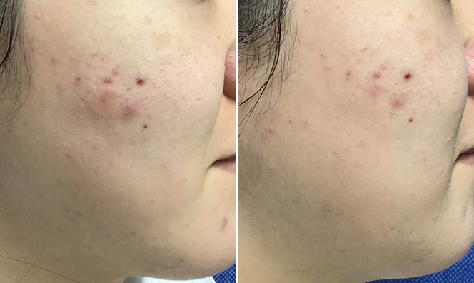 ダーマペン GHD+ウーバーピール 頬・あご 治療前/1回目治療後