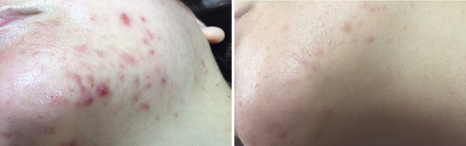 ダーマペン+ウーバーピール あご 治療前/1回目治療後