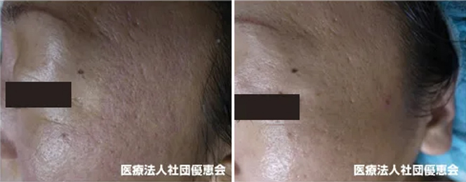 ダーマペン GHD 頬 治療前/治療後