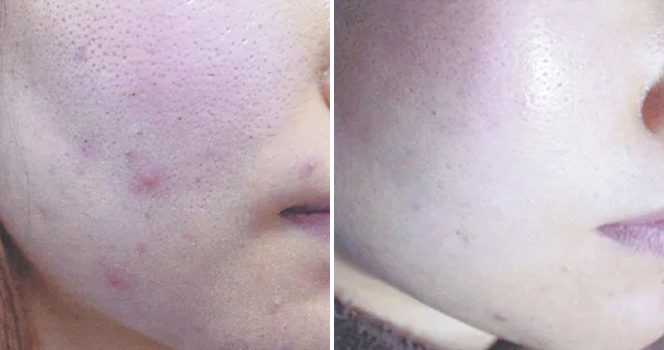 ダーマペン GHD+ピーリング 鼻・頬 治療前/4回目治療後