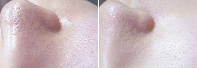 ダーマペン GHD+ピーリング 鼻・頬 治療前/4回目治療後