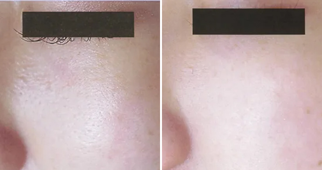 ダーマペン GHD 頬+成長因子パック+トーニング+TA導入 治療前/5回目治療後