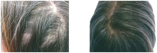 APRILINE HAIRLine 注射 4回 左:施術前 / 右:施術後