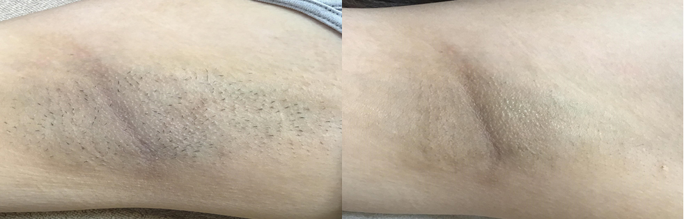 脇の黒ずみ治療(ピーリング+レーザートーニング+イオン導入)+脱毛 施術前 / ワキの黒ずみ治療15回+脱毛5回施術後