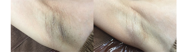 脇の黒ずみ治療(ピーリング+レーザートーニング+イオン導入) 治療前 / 20回治療後