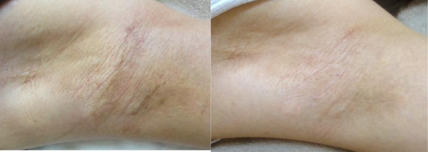 レーザートーニング 脇 治療前 / 20回治療後