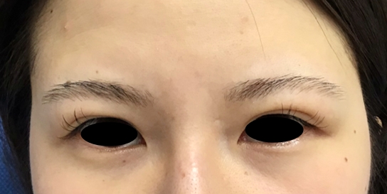 ReLift(リリフト・目元) 1回 治療直後