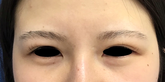 ReLift(リリフト・目元) 1回 治療前