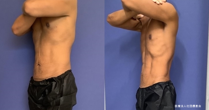 腹部リアクション+EMS 3回 治療前 / 治療後