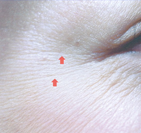 目尻のちりめんじわ(ボトックス目尻(筋肉)+ボトックス目尻(マイクロ)) 治療前