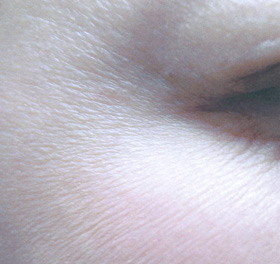 目尻のちりめんじわ(ボトックス目尻(筋肉)+ボトックス目尻(マイクロ)) 注入2週間後