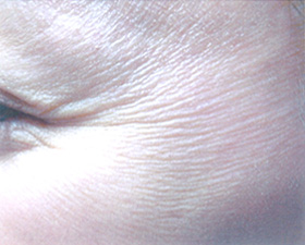 目尻のちりめんじわ(ボトックス目尻(筋肉)+ボトックス目尻(マイクロ)) 治療前