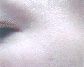 目尻のちりめんじわ(ボトックス目尻(筋肉)+ボトックス目尻(マイクロ)) 注入2週間後