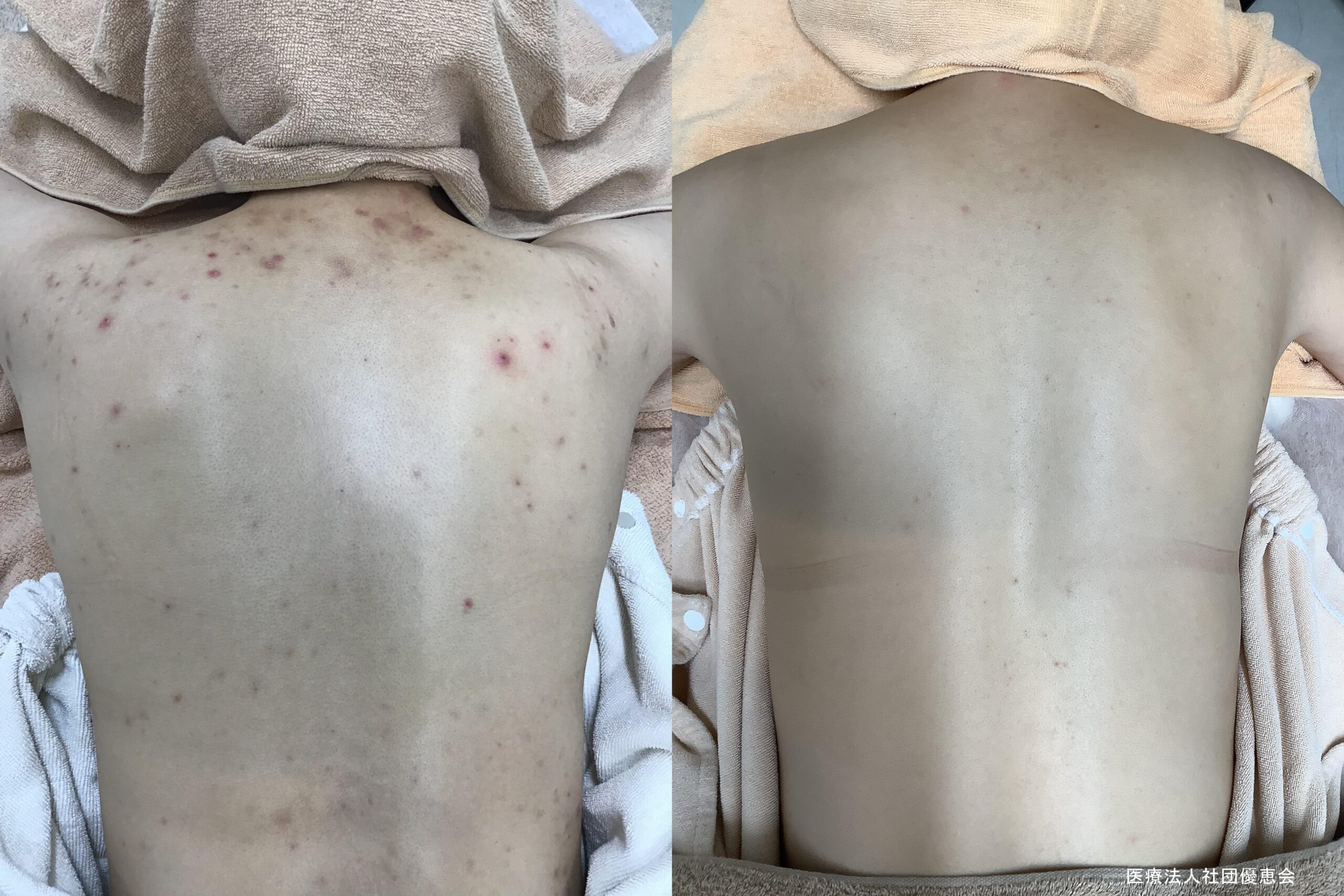 背中パーフェクト 15回 施術前 / 15回終了後