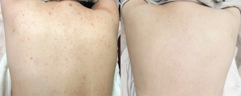 背中パーフェクトコース(ピーリング + ジェネシス + ビタミンC導入) 治療前 / 治療後