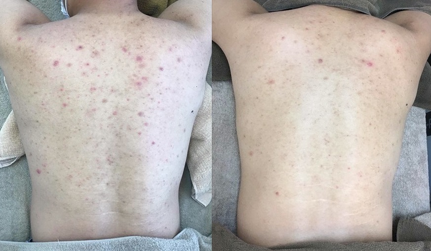 背中パーフェクトコース+背中下部ピーリング 左:治療前 / 右:5回目治療後