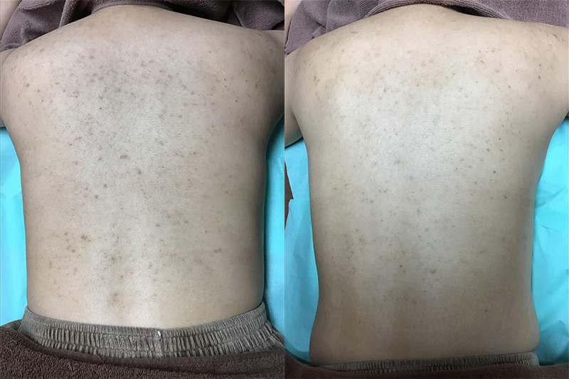 背中パーフェクトコース(ピーリング + ジェネシス + ビタミンC導入) 治療前 / 10回治療後