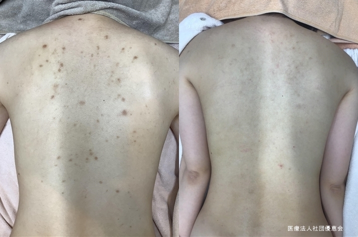 背中パーフェクトW(BHA+ピコトーニング) 全20回 施術前 / コース終了後