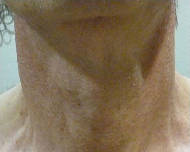 リアクションST 首 2回目治療後