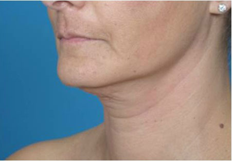 ReLiftトリートメント 首 9回目治療後