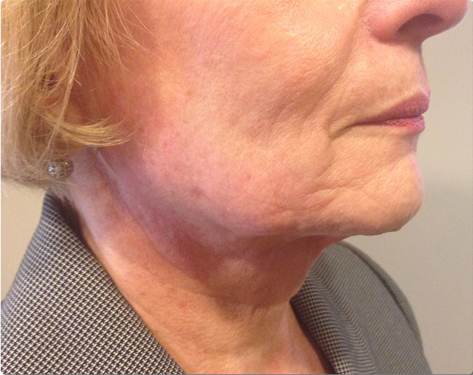 リアクション 首+頬 1回目治療後