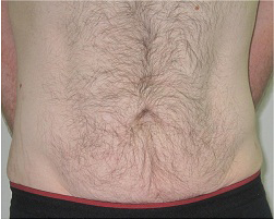 ReFit 腹部 治療後