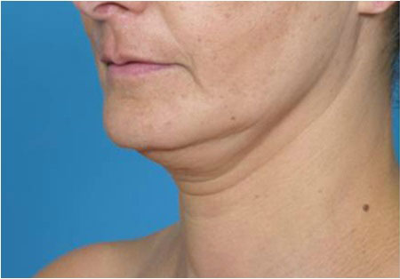 ReLiftトリートメント 首 治療前