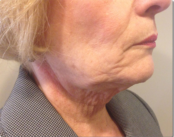 リアクション 首+頬 治療前