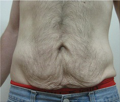 ReFit 腹部 治療前