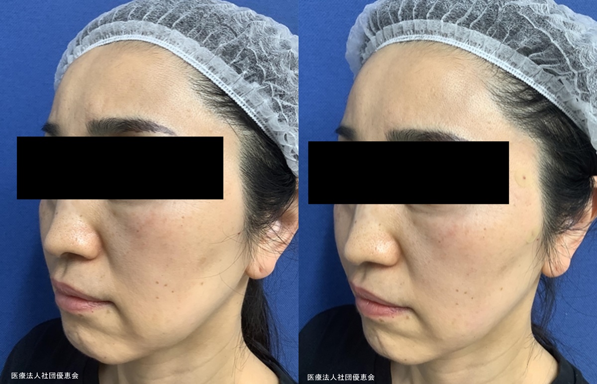 スレッド フィオラジグザグ8本 治療前 / 治療後