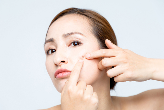 ニキビ跡はどうやったら消える?赤み、色素沈着、クレーター肌、ニキビ跡の治し方