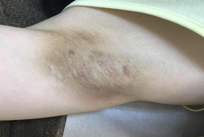 脇の黒ずみはどうしたら取れる? 4つの正しい治療法を医師が解説