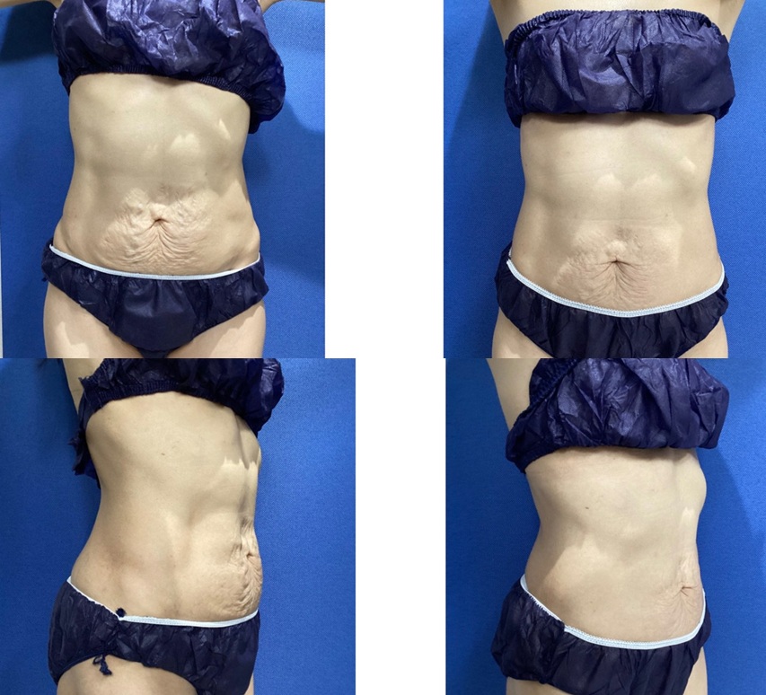 リフィット(リアクションボディ)+EMS15回 施術前 / 施術後