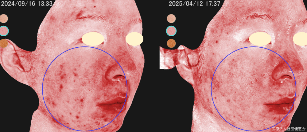 エオニアン　全顔5回 施術前 / 5回終了後