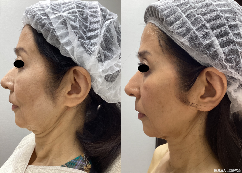 ボトックスリフト1回　60代女性 施術前 / 4ヵ月後